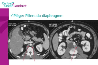 Piége: Piliers du diaphragme 