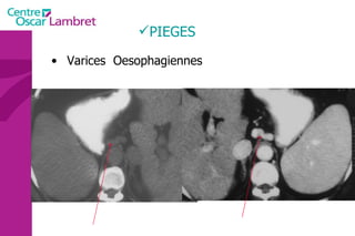 PIEGES Varices  Oesophagiennes 