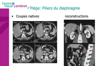Piége: Piliers du diaphragme Coupes natives  reconstructions 