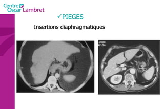 PIEGES Insertions diaphragmatiques 