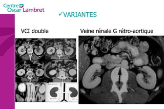 VARIANTES VCI double   Veine rénale G rétro-aortique  