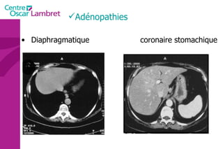 Adénopathies Diaphragmatique coronaire stomachique  