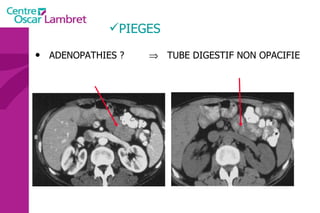PIEGES ADENOPATHIES ?    TUBE DIGESTIF NON OPACIFIE 