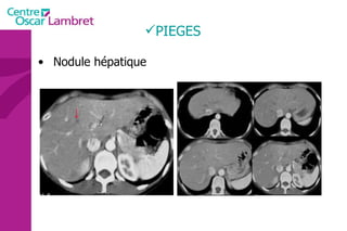 PIEGES Nodule hépatique 