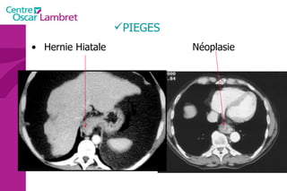 PIEGES Hernie Hiatale   Néoplasie 
