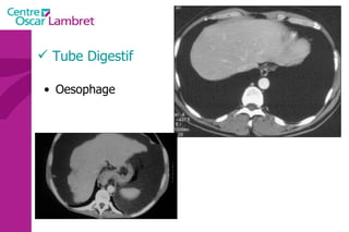 Tube Digestif Oesophage  