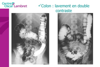 Colon : lavement en double contraste 