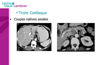 Tronc Coeliaque Coupes natives axiales 