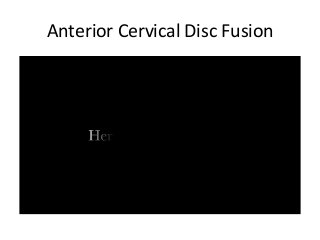 Anterior	Cervical	Disc	Fusion	
 