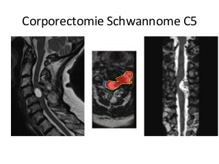 Corporectomie	Schwannome	C5	
 