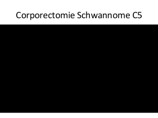 Corporectomie	Schwannome	C5	
 
