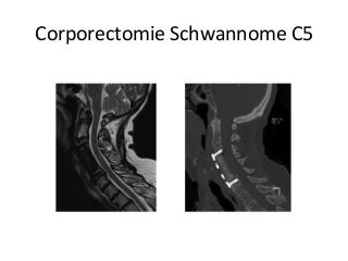 Corporectomie	Schwannome	C5	
 