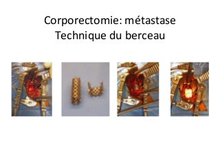 Corporectomie:	métastase		
Technique	du	berceau		
 