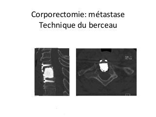 Corporectomie:	métastase		
Technique	du	berceau		
 