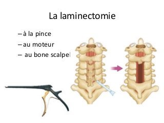 – à	la	pince		
– au	moteur	
– 	au	bone	scalpel			
La	laminectomie		
 