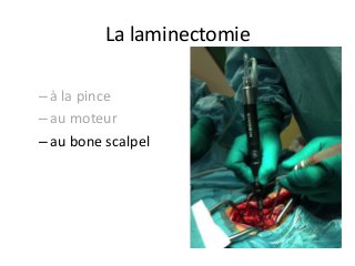 – à	la	pince		
– au	moteur	
– au	bone	scalpel			
La	laminectomie		
 
