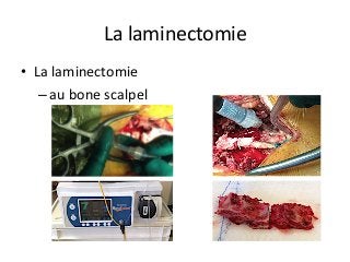 •  La	laminectomie	
– au	bone	scalpel			
La	laminectomie		
 
