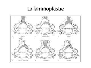 La	laminoplasJe		
 