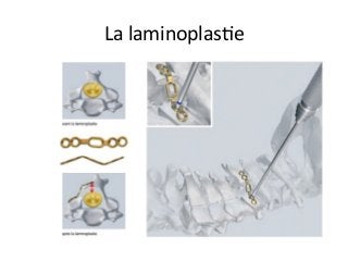La	laminoplasJe		
 