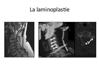 La	laminoplasJe		
 