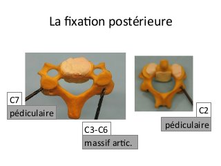 La	ﬁxaJon	postérieure		
C7	
C3-C6	
C2	pédiculaire	
massif	arJc.		
pédiculaire		
 