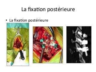 •  La	ﬁxaJon	postérieure			
La	ﬁxaJon	postérieure		
 