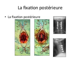 •  La	ﬁxaJon	postérieure			
La	ﬁxaJon	postérieure		
 
