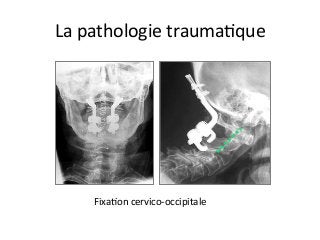 FixaJon	cervico-occipitale	
La	pathologie	traumaJque	
 