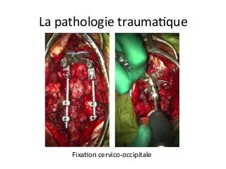 FixaJon	cervico-occipitale	
La	pathologie	traumaJque	
 