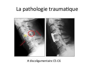 C5	
#	discoligamentaire	C5-C6	
La	pathologie	traumaJque	
 