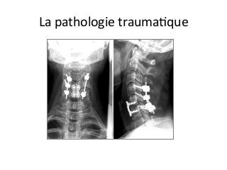 La	pathologie	traumaJque	
 