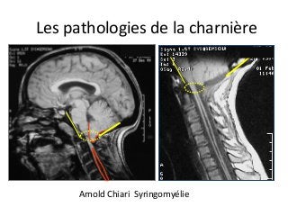 Arnold	Chiari		Syringomyélie	
Les	pathologies	de	la	charnière	
 