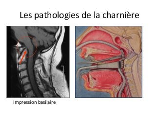 Impression	basilaire	
Les	pathologies	de	la	charnière	
 