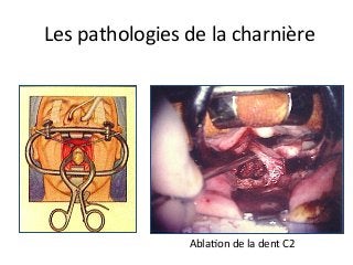 Les	pathologies	de	la	charnière	
AblaJon	de	la	dent	C2	
 