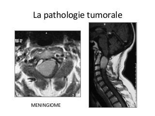 MENINGIOME	
La	pathologie	tumorale	
 