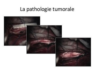 La	pathologie	tumorale	
 