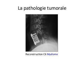 La	pathologie	tumorale	
ReconstrucJon	C6	Myélome	
 