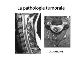 La	pathologie	tumorale	
CAVERNOME	
 