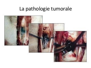 La	pathologie	tumorale	
 