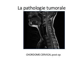 CHORDOME	CERVICAL	post	op		
La	pathologie	tumorale	
 