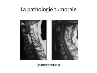 ASTROCYTOME	III	
La	pathologie	tumorale	
 