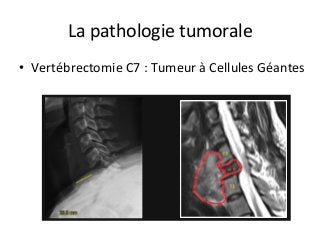 •  Vertébrectomie	C7	:	Tumeur	à	Cellules	Géantes	
La	pathologie	tumorale	
 