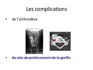 Les	complicaJons		
•  de	l’arthrodèse	
•  du	site	de	prélèvement	de	la	greﬀe		
 