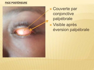 FACE POSTÉRIEURE
 Couverte par
conjonctive
palpébrale
 Visible après
éversion palpébrale
 