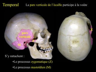 Temporal La pars verticale de l’écaille participe à la voûte
pars
verticale
S’y rattachent :
•Le processus mastoïdien (M)
M
•Le processus zygomatique (Z)
Z
Z
 