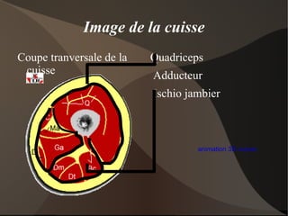1 ménisque interne en forme de C et un ménisque externe en forme de O ouvert. 