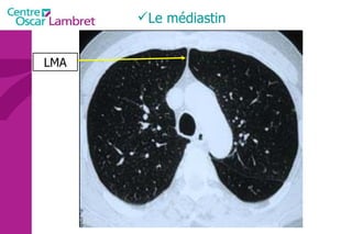 Le médiastin LMA 