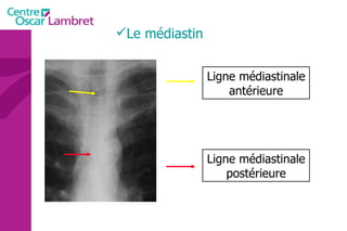 Ligne médiastinale postérieure Ligne médiastinale antérieure Le médiastin 