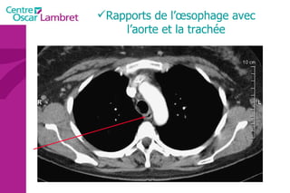 Rapports de l’œsophage avec l’aorte et la trachée 
