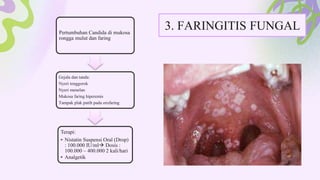 3. FARINGITIS FUNGAL
Pertumbuhan Candida di mukosa
rongga mulut dan faring
Gejala dan tanda:
Nyeri tenggorok
Nyeri menelan
Mukosa faring hiperemis
Tampak plak putih pada orofaring
Terapi:
• Nistatin Suspensi Oral (Drop)
: 100.000 IU/ml Dosis :
100.000 – 400.000 2 kali/hari
• Analgetik
 